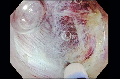 Transverse Colon ESD Submucosal Dissection